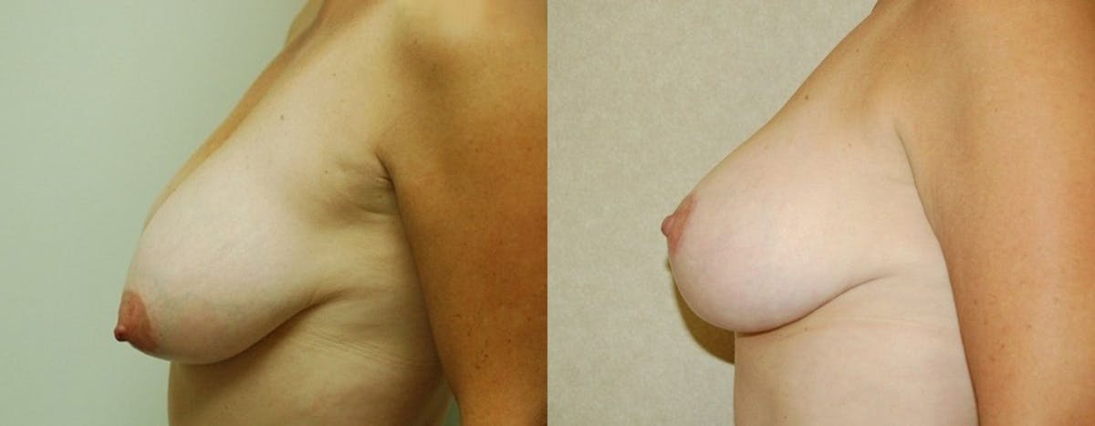 Breast Lift Before & After Gallery - Patient 137367 - Image 1