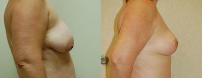 Breast Lift Before & After Gallery - Patient 322771 - Image 1