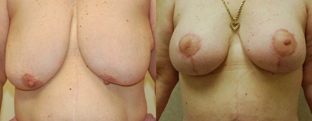 Breast Lift Before & After Gallery - Patient 351787 - Image 1