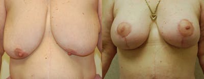 Breast Lift Before & After Gallery - Patient 351787 - Image 1
