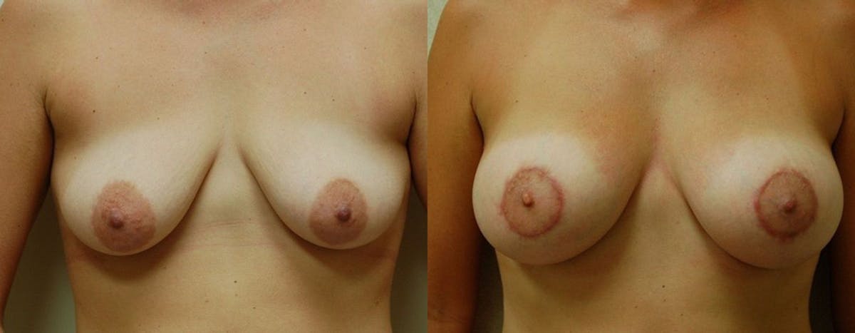 Breast Lift Before & After Gallery - Patient 269374 - Image 1