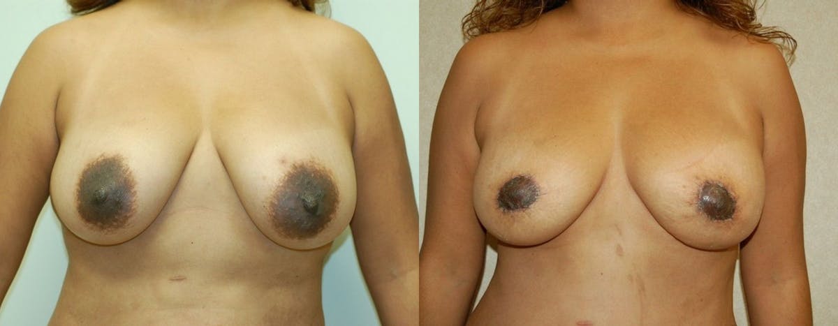Breast Lift Before & After Gallery - Patient 354101 - Image 1