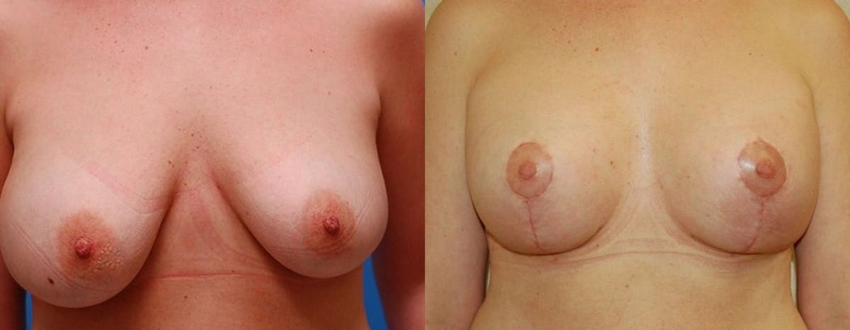 Breast Lift Before & After Gallery - Patient 421127 - Image 1