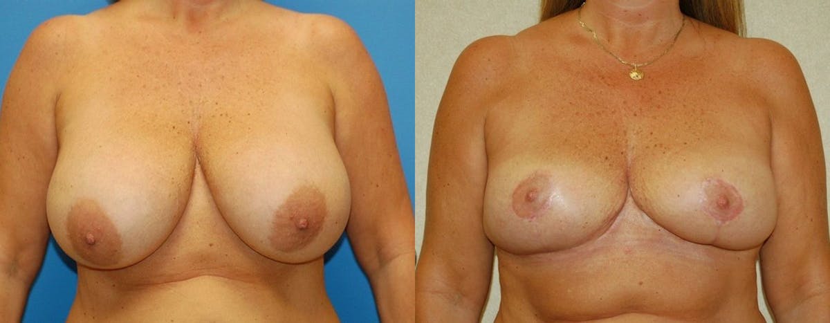 Breast Lift Before & After Gallery - Patient 531592 - Image 1