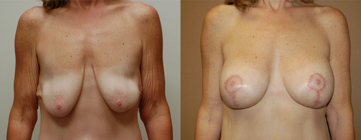Breast Lift Before & After Gallery - Patient 266405 - Image 1