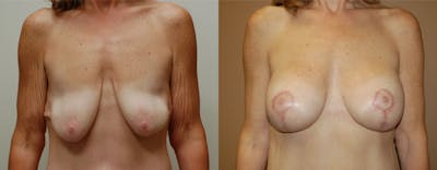 Breast Lift Before & After Gallery - Patient 266405 - Image 1
