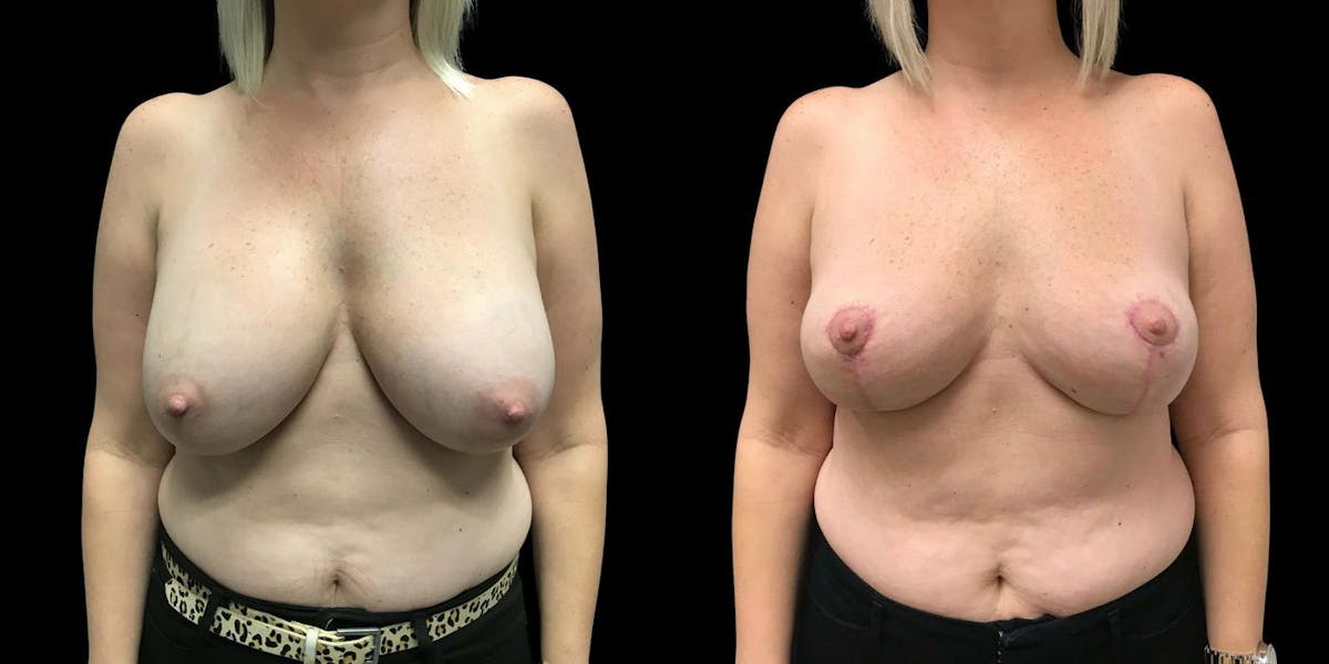 Implant Removal Before & After Gallery - Patient 136490 - Image 1