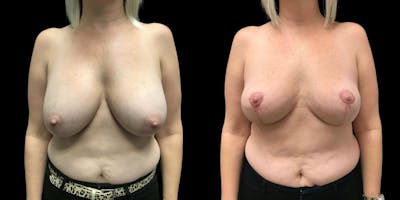 Implant Revision Before & After Gallery - Patient 285582 - Image 1