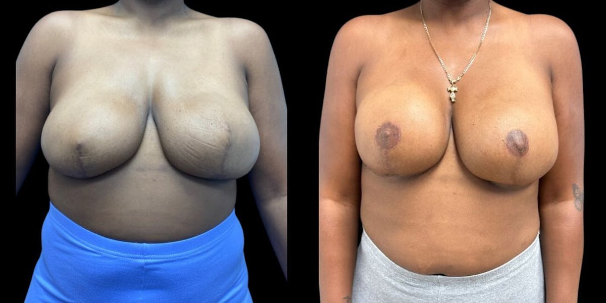 Breast Reconstruction Before & After Gallery - Patient 391084 - Image 1