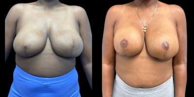 Breast Reconstruction Before & After Gallery - Patient 391084 - Image 1