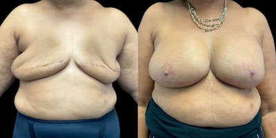Breast Reconstruction Before & After Gallery - Patient 277896 - Image 1