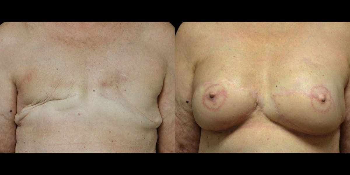 Breast Reconstruction Before & After Gallery - Patient 383394 - Image 1