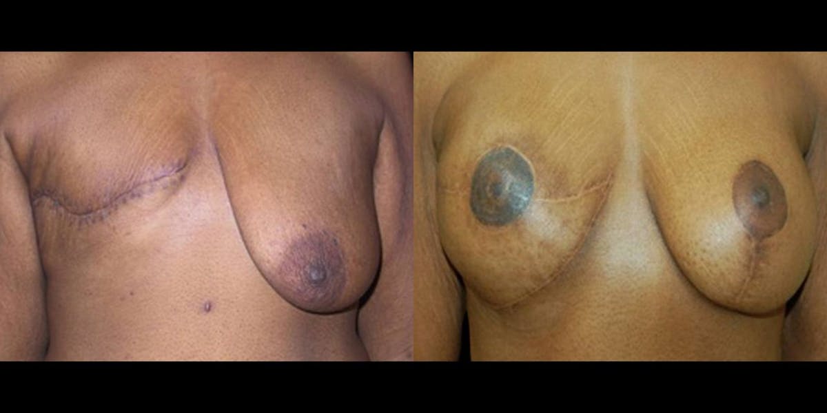Breast Reconstruction Before & After Gallery - Patient 243450 - Image 1