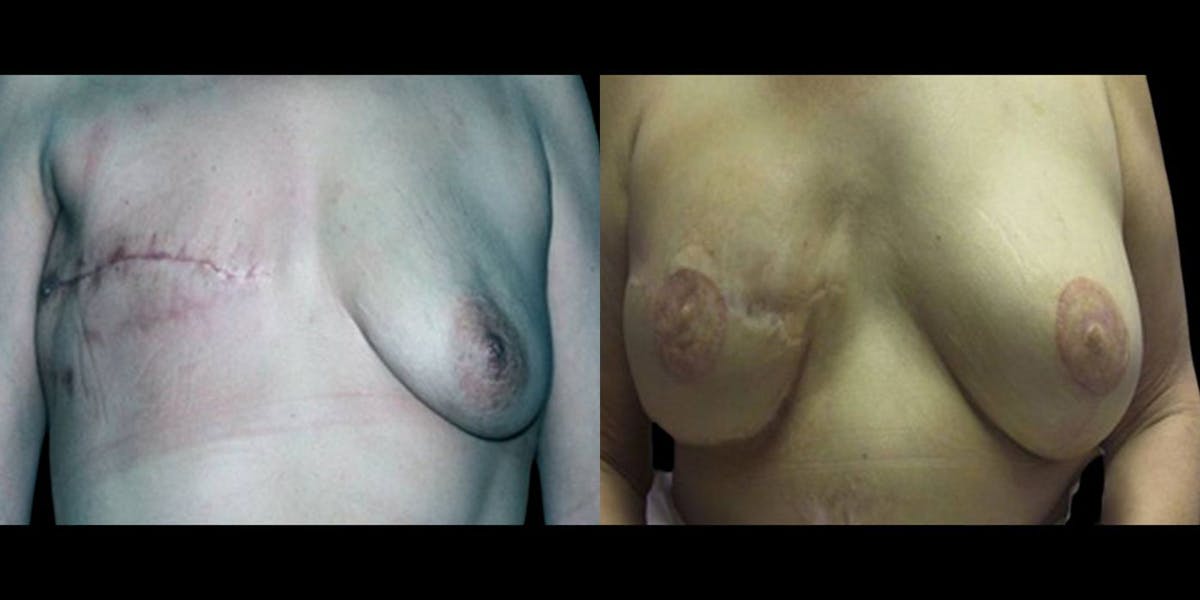 Breast Reconstruction Before & After Gallery - Patient 252022 - Image 1