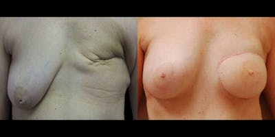 Breast Reconstruction Before & After Gallery - Patient 113424 - Image 1