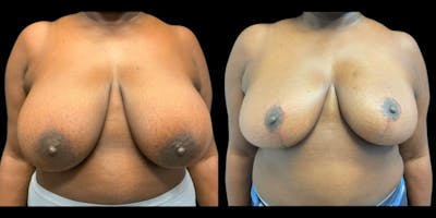 Breast Reduction Before & After Gallery - Patient 303792 - Image 1