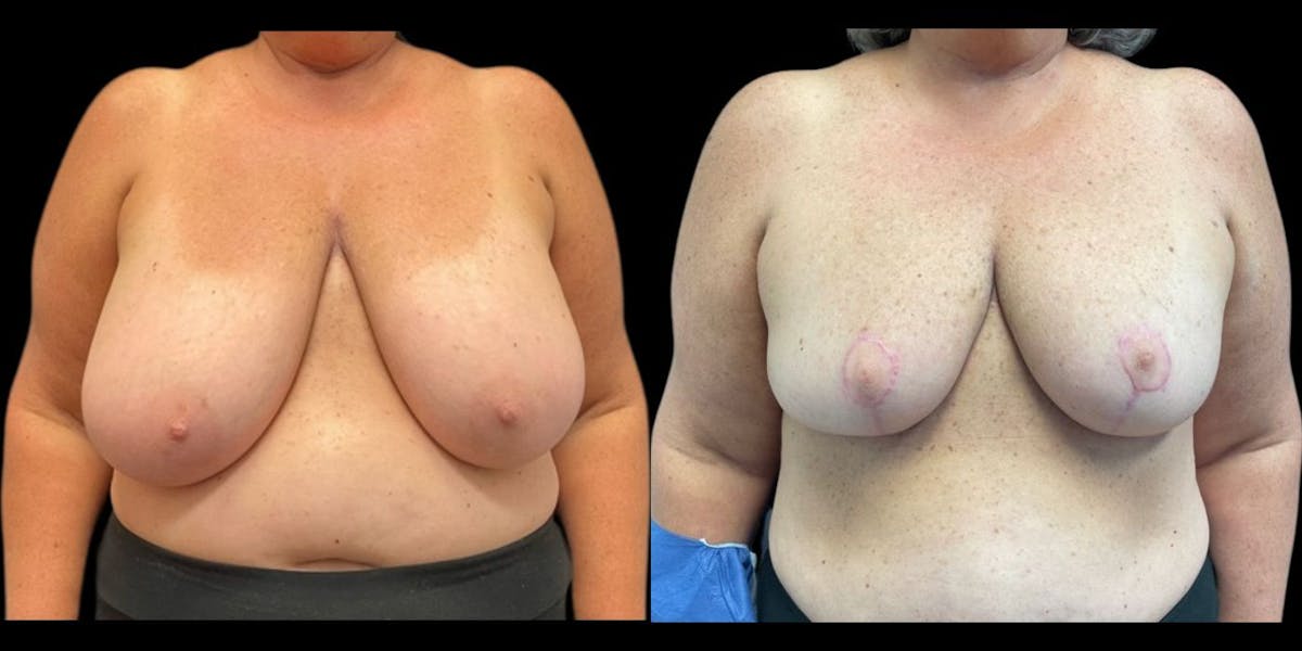 Breast Reduction Before & After Gallery - Patient 347947 - Image 1