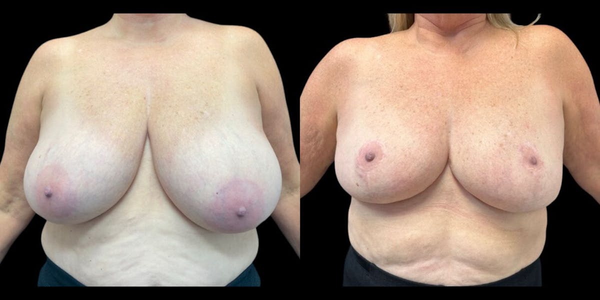 Breast Reduction Before & After Gallery - Patient 429348 - Image 1