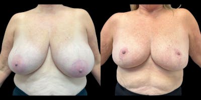 Breast Reduction Before & After Gallery - Patient 429348 - Image 1