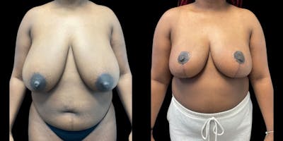 Breast Reduction Before & After Gallery - Patient 108123 - Image 1