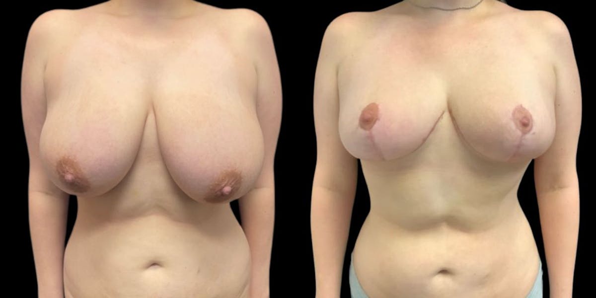 Breast Reduction Before & After Gallery - Patient 212974 - Image 1