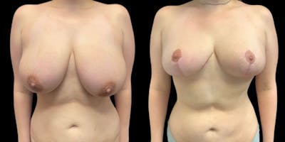 Breast Reduction Before & After Gallery - Patient 212974 - Image 1
