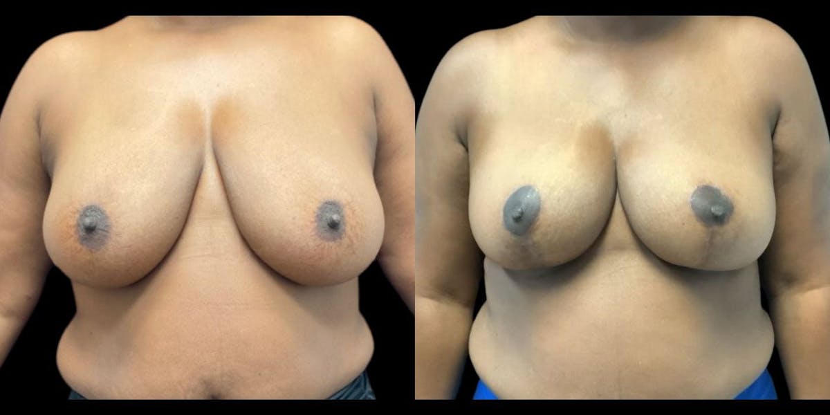 Breast Reduction Before & After Gallery - Patient 304938 - Image 1