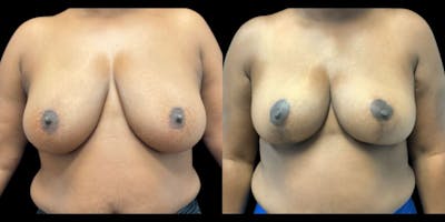 Breast Reduction Before & After Gallery - Patient 304938 - Image 1