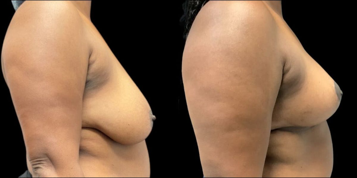 Breast Reduction Before & After Gallery - Patient 417327 - Image 1