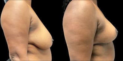 Breast Reduction Before & After Gallery - Patient 417327 - Image 1