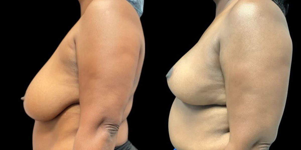 Breast Reduction Before & After Gallery - Patient 385163 - Image 1