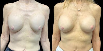 Implant Revision Before & After Gallery - Patient 100773 - Image 1