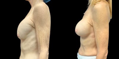 Implant Revision Before & After Gallery - Patient 427770 - Image 1