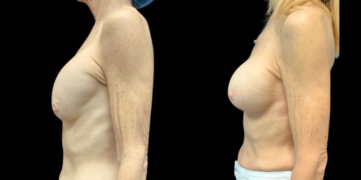 Implant Revision Before & After Gallery - Patient 427770 - Image 1