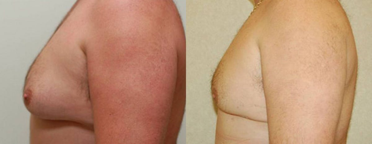 Gynecomastia Before & After Gallery - Patient 205687 - Image 1