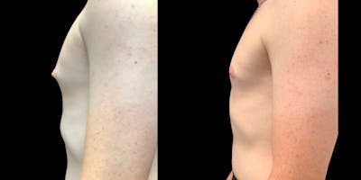 Gynecomastia Before & After Gallery - Patient 683679 - Image 1