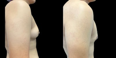 Gynecomastia Before & After Gallery - Patient 249103 - Image 1