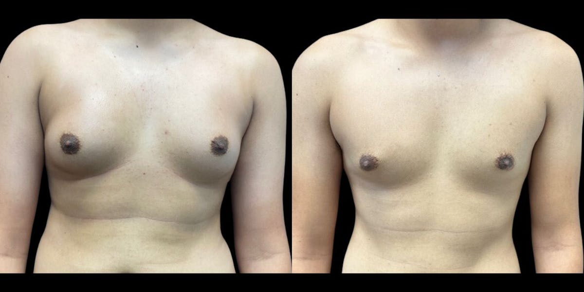 Gynecomastia Before & After Gallery - Patient 617822 - Image 1