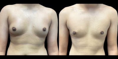 Gynecomastia Before & After Gallery - Patient 617822 - Image 1