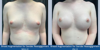 Top Surgery - Feminization Before & After Gallery - Patient 426874 - Image 1