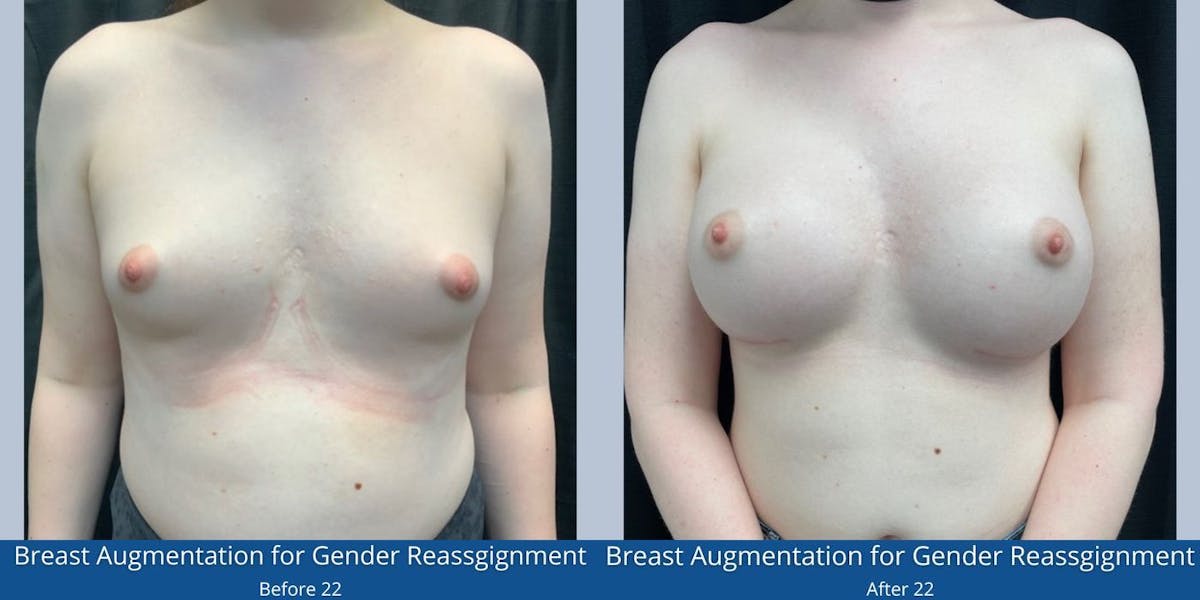 Top Surgery - Feminization Before & After Gallery - Patient 426874 - Image 1