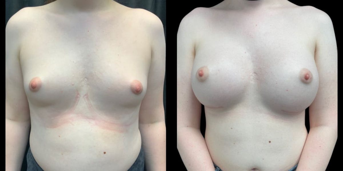 Top Surgery - Feminization Before & After Gallery - Patient 224765 - Image 1