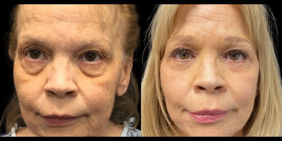 Blepharoplasty Before & After Gallery - Patient 215772 - Image 1