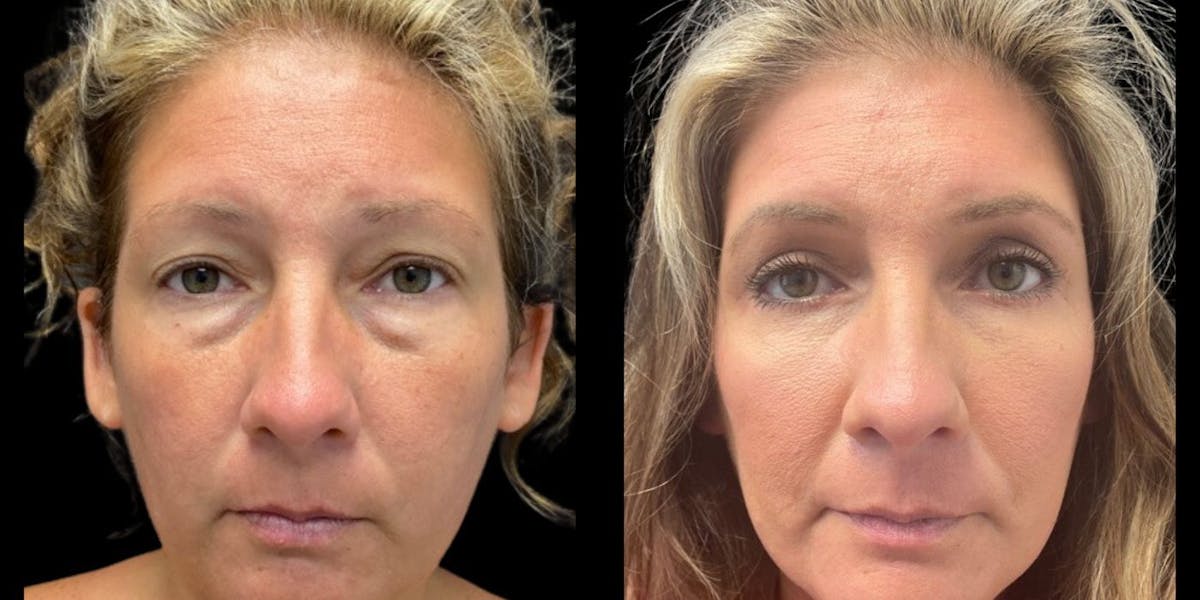 Blepharoplasty Before & After Gallery - Patient 377715 - Image 1