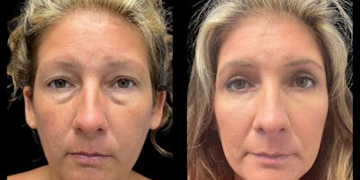 Blepharoplasty Before & After Gallery - Patient 377715 - Image 1