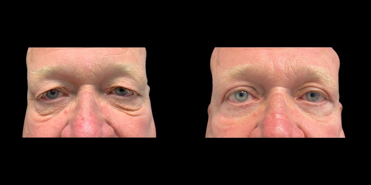 Blepharoplasty Before & After Gallery - Patient 267548 - Image 1