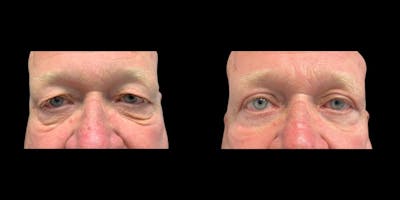Blepharoplasty Before & After Gallery - Patient 267548 - Image 1
