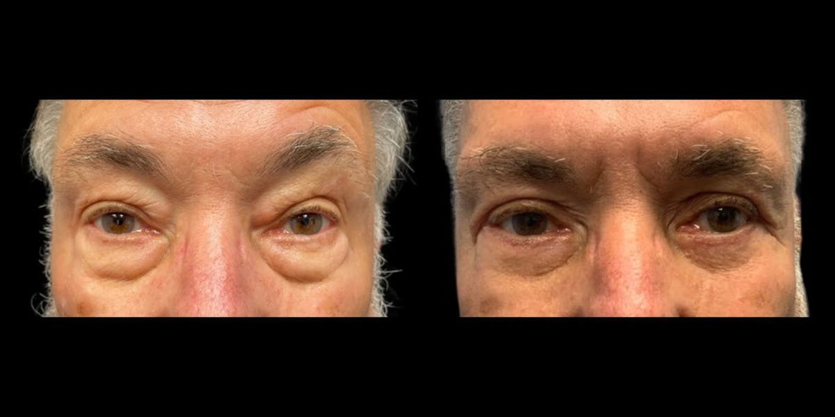 Blepharoplasty Before & After Gallery - Patient 776575 - Image 1