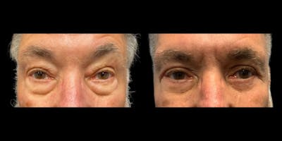 Blepharoplasty Before & After Gallery - Patient 776575 - Image 1
