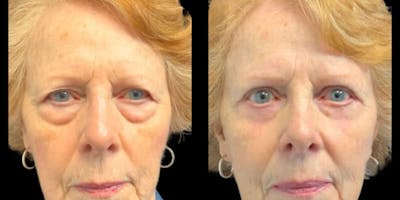 Blepharoplasty Before & After Gallery - Patient 367488 - Image 1